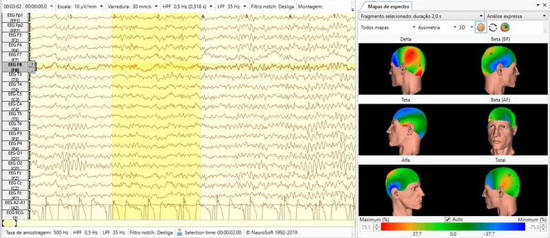 Mapeamento Cerebral qEEG EEG Quantitativo